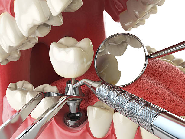 Best Emergency Treatment for Dental Infections or Abscesses in Grapevine, TX